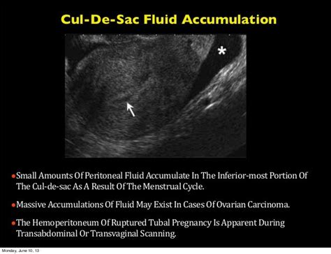 cul fill|small amount of free fluid in the cul de sac.